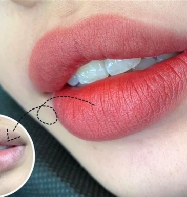 Xử Lý Khử Thâm Môi